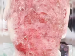 罕见病患者蝴蝶宝贝的真实生活