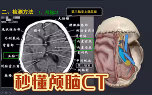 一个视频掌握颅脑CT