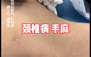 针灸治疗颈椎病/手麻
