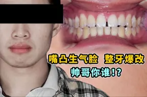 【嘴凸下巴后缩男生】生气脸整牙爆改高级气质脸！