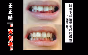 95%的人，都不知道的假性“深覆合”