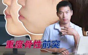 正畸极限内收15mm代替正颌手术