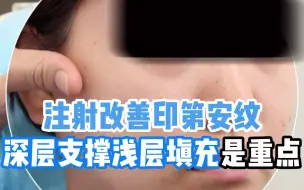 玻尿酸注射：改善印第安纹一定要深层+浅层！