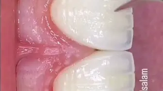 牙齿贴面