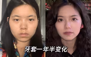 普通女孩牙套一年半变化～