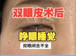 以前睁不开，现在闭不上，双眼皮术后眼睛闭不上怎么办？睁眼睡觉