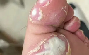 。跖疣脱落过程太解压了吧