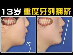 【正畸博士】门牙外飘，牙齿严重拥挤，矫正一年半后，下巴颏出来了，牙齿变整齐，侧颜也更立体精致了