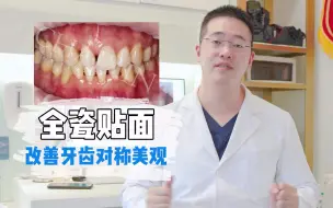 全瓷贴面修复牙齿对称美观