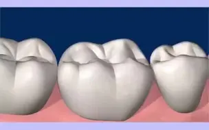 牙釉质缺了一块怎么办呢