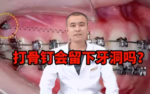 打骨钉会留下牙洞吗
