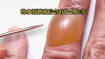 你们知道手上长了一个水泡后，戳破它会有什么危害吗？看完你就明白了。