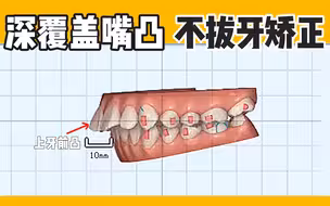 深覆盖嘴凸，不拔牙矫正动画演示