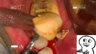 洗牙 恶心中带着过瘾