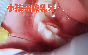 小男孩一个牙位长了两颗牙齿，妈妈赶紧带去医院拔掉一颗