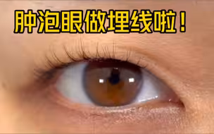 肿泡眼的我，选择埋线啦！