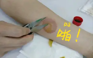 【重口慎入】挑破烫伤水泡，噗！