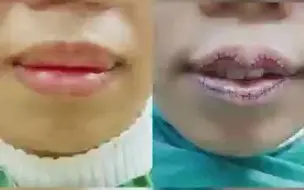 【东华整形】厚唇改薄塑型