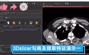 【影像组学】3D slcier勾画及特征提取演示一