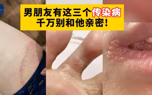 【科普】如果男朋友有这三个传染病，要等他好了才能和他亲密！