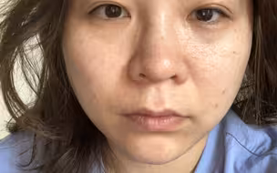 上周二去做M22的光子嫩肤！感觉医美真的很神奇啊！iPhone前置，我是真的很多很多痘印，立竿见影的淡化了广州已经痘痘没停过我还手很欠喜欢扣痘痘！惊喜！惊喜