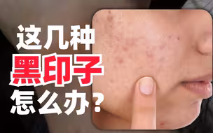 【科普】身上的黑印子封印了你的颜值？孙叔教你处理色素沉着
