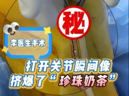 痛风朋友关节里藏了杯珍珠奶茶