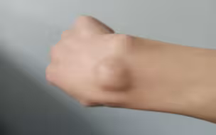 术式展开—腱鞘囊肿秒杀