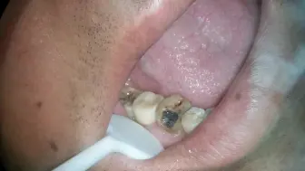 蛀牙不处理，难道非要等到疼的痛不欲生嘛？