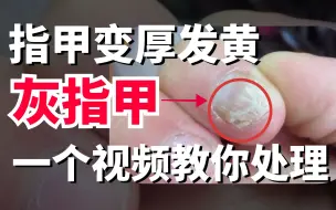 【科普】为什么灰指甲修掉之后，长出来的还是灰指甲？