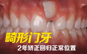 一颗门牙长在牙肉里？2年矫正强制性归位