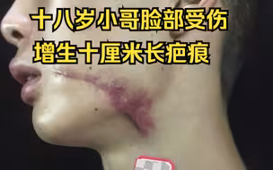 十八岁小哥脸上受伤，增生十厘米的长疤痕，看看是如何让它消失的