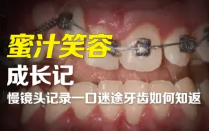 慢镜头记录一口迷乱不堪牙齿的矫正还原过程