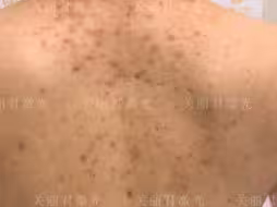 严重的后背痘印，疤痕，扁平疣。痘印是困扰很多人的疑难问题，我这里很常见了