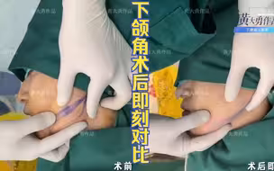 [黄大勇改脸型]每一位术前都会进行充分的沟通和划线设计说明，下颌角即刻变美对比