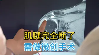 哎呦，这打球够贵的，胳膊肌腱完全断了，得抓紧肩关节镜手术