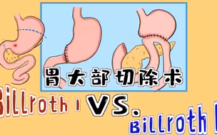 漫画|胃大切【毕I式 VS. 毕II式】
