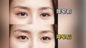 双眼皮宽改窄为什么变普？