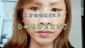 大拉皮14天，55岁姐姐面部状态大公示，是不是恢复的不错