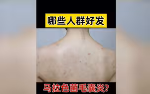 哪些人群好发马拉色菌毛囊炎？对症治疗很重要