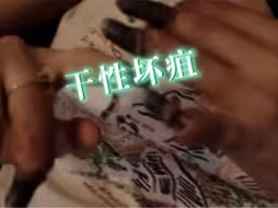 手指干性坏疽严重到能自己掰断，慎看