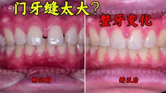 门牙缝太大？看整牙后的惊喜变化