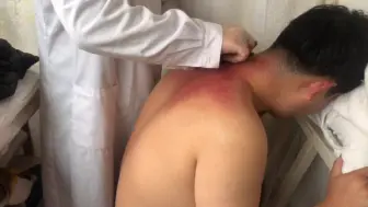刮痧治疗感冒喉咙痛，就刮三角区，老偏方效果好见效快，不妨试试