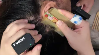 沉浸式去除头皮屑
