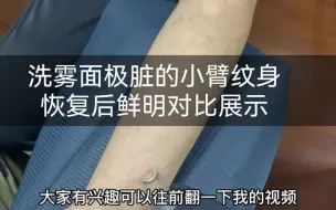 洗一个雾面极脏的小臂，终于接近尾声。恢复后的对比非常鲜明。最近大家都在问针眼长什么样，看完这个视频你就明白。