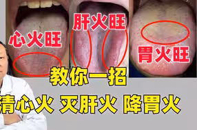 舌尖红心火、舌边红肝火、舌中黄胃火，教你一招，清心火，灭肝火，降胃火