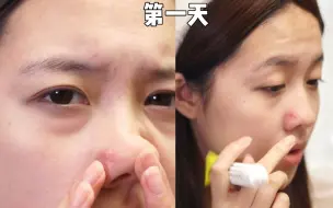 战痘经历