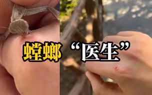 女子上山抓螳螂“治疗”手上肉疙瘩：有点疼，不建议盲目尝试