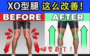 【奥运冠军的康复专家】腿变直了！普通人如何在家矫正XO型腿？（超详细跟练教程）
