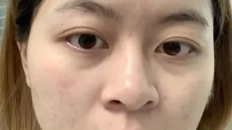 第一次做点阵激光的全过程